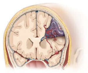 Arteriovenous_Malformation_Fig_1