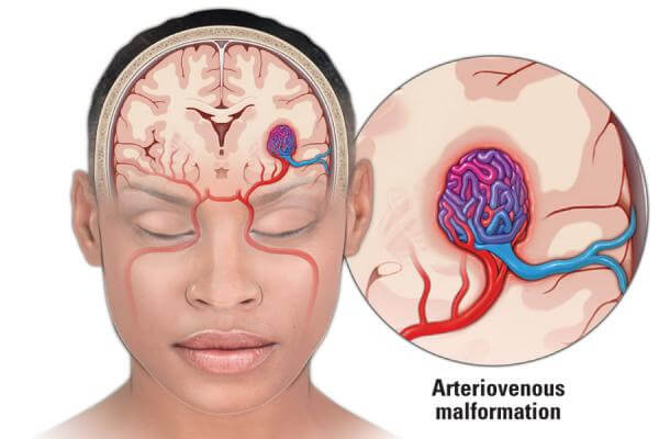 arteriovenous-malformation