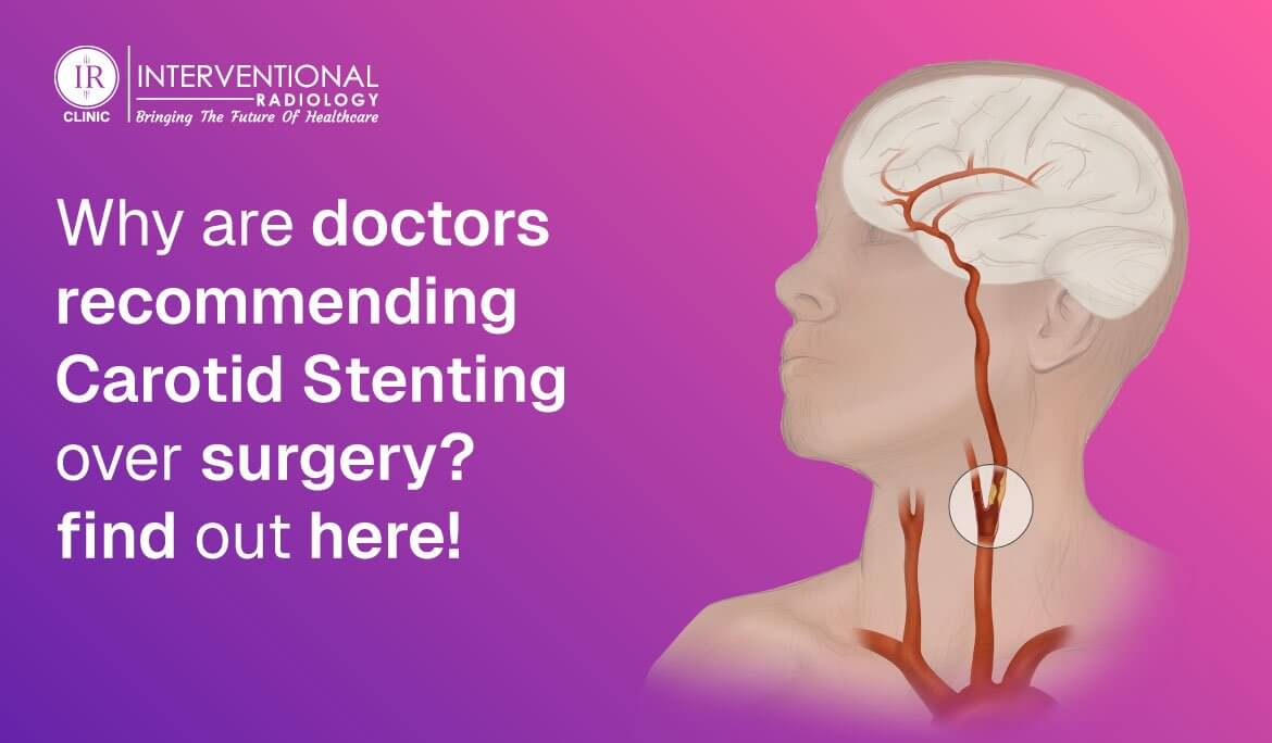 carotid stenting over surgery