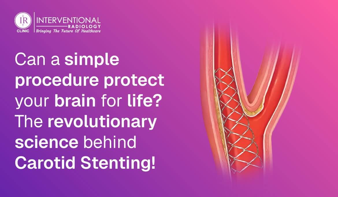 carotid stenting